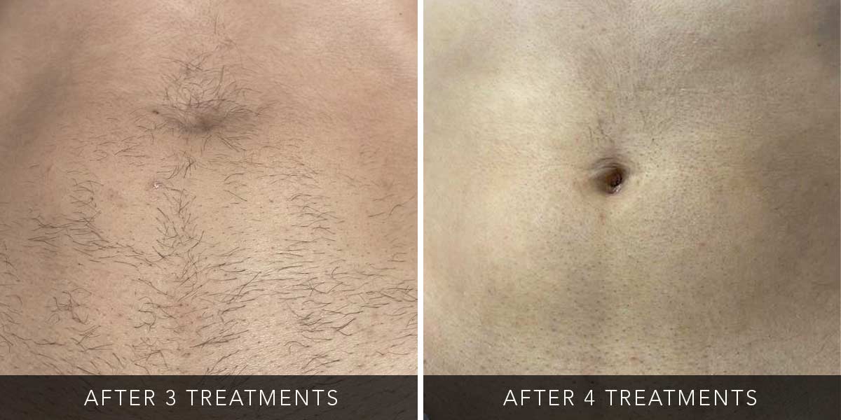 Before-After-Eneka-02