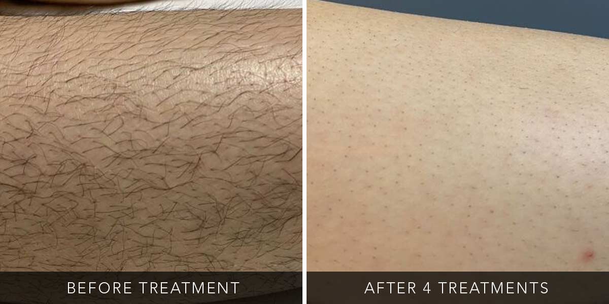 Before-After-Eneka-06